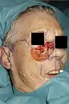 Moderate-sized anterior cheek defect