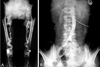 A. Pelvic and lower extremity radiograph shows extensive calcification of the femoral arteries. B. Translumbar aortography shows near-total obstruction of the femoral arteries.