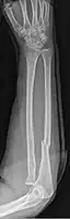 Monteggia fracture (fracture of proximal ulna)