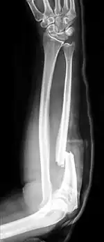 Monteggia fracture (type of ulna fracture)