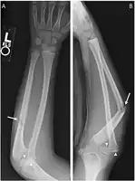 Monteggia fracture