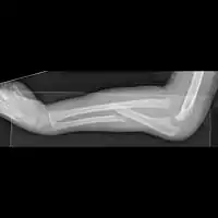 Monteggia fracture dislocation