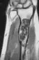 MRI showing enchondromas localized in the lower part of the radius of a 37-year-old patient affected with Ollier disease