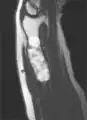 MRI showing enchondromas localized in the lower part of the radius of a 37-year-old patient affected with Ollier disease.