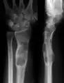 X-ray showing enchondromas localized in the lower part of the radius of a 37-year-old patient affected with Ollier disease