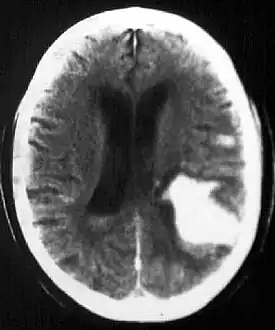 CT-scan of intraparenchymal hemorrhage