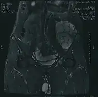 MRI of a left-pelvis chondrosarcoma in a 26-year-old male