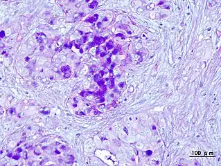 Histopathologic image of mucoepidermoid carcinoma. Postoperative recurrence of the submandibular tumor. Alcian blue-PAS stain
