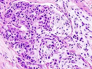 Histopathologic image of mucoepidermoid carcinoma of the major salivary gland. H & E stain