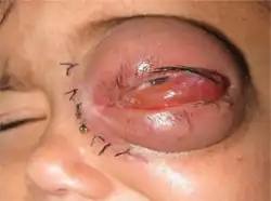 Swelling of upper and lower eyelid