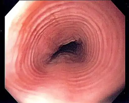 Endoscopic image of esophagus in a case of eosinophilic esophagitis.  Concentric rings are termed trachealization of the esophagus.