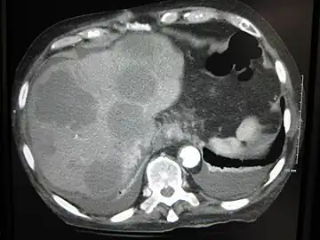 Axial CT of the abdomen showing multiple liver metastases