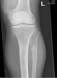multiple osteochondromas around the knee