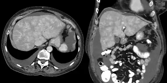 CT appearance of liver in congestive hepatopathy, sometimes referred to as a nutmeg liver. Due to congestion, contrast does not flow through the liver in a normal manner. Axial and coronal images in the portal venous phase.