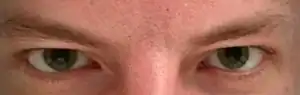 Patient with mydriasis due to usage of LSD