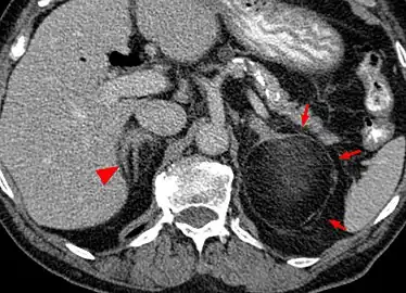 Myeloplipoma shown on a CT scan image