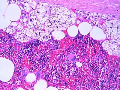The microscopic view of a myelolipoma shows the presence of normal adrenal cells, fat (adipose) cells, and the three lineages of the myeloid precursors