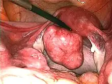 Large subserosal fibroid