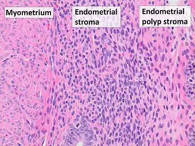 Myometrium (smooth muscle cells) versus endometrial stroma (more cellular) versus endometrial polyp stroma (more collagenous). H&E stain