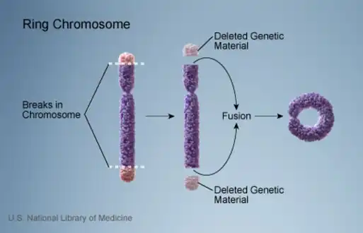 Formation of a ring chromosome.