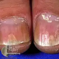 Nail psoriasis