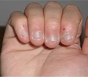 Multiple, dystrophic, irregular, shortened fingernails