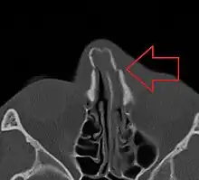 Bilateral nasal fracture as seen on CT scan