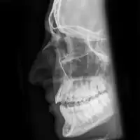 Nasal bone fracture
