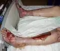 Toxic epidermal necrolysis on legs