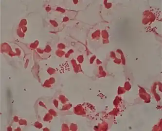 Neisseria gonorrhoeae and pus cells from a penile discharge (Gram stain)