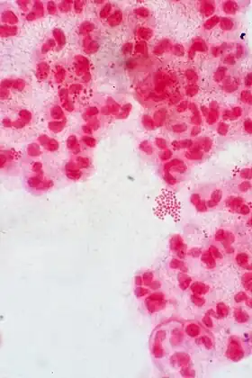 A Gram stain of a urethral exudate showing typical intracellular Gram-negative diplococci, which is diagnostic for gonococcal urethritis