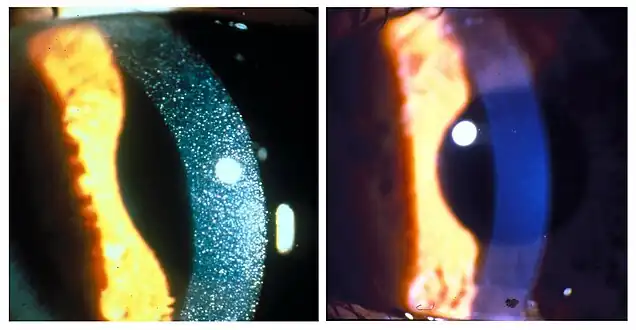 Slit-lamp photographs of three-year-old patient with nephropathic cystinosis before (left) and after (right) cysteamine eyedrop therapy. The drops dissolve the crystals in the cornea.