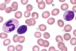 Neutrophil (left) and lymphocytes (right) seen microscopically on a blood smear