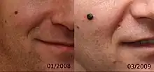 Evolution of a 4 mm nodular melanoma.