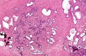 Micrograph showing nodular hyperplasia (left off center) of the prostate from a transurethral resection of the prostate (TURP). H&E stain.