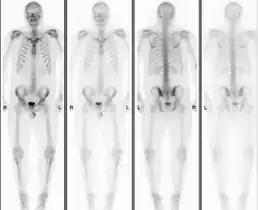 Normal bone scan in a person with osteopoikilosis