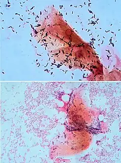 In bacterial vaginosis, beneficial bacteria in the vagina (top) are displaced by pathogens (bottom). Gram stain.