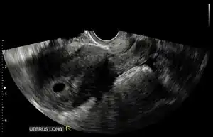Ultrasound: early pregnancy