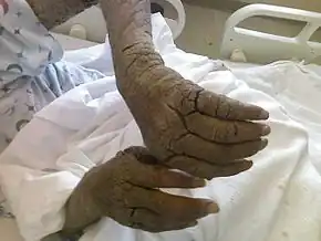 Diffuse thickening of the skin over an adult's bilateral arms and fingers