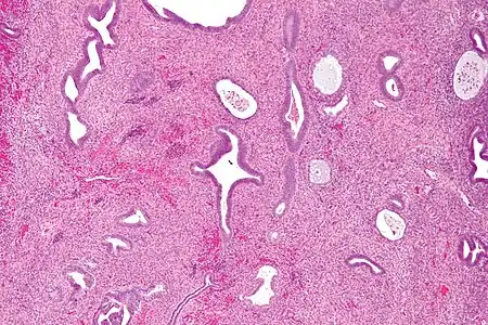 Micrograph of an endometrial polyp. H&E stain