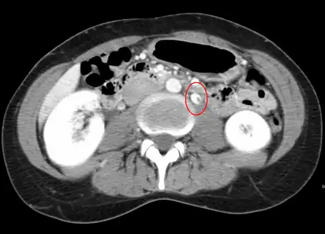 CT showing dilatation and thrombosis of the left renal vein in a patient with nutcracker syndrome