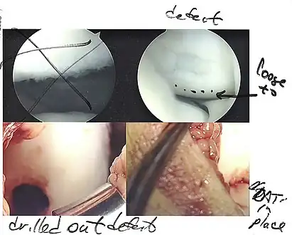 Arthroscopic image of OATS surgery on the medial femoral condyle of the knee