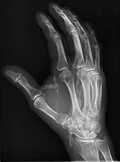 Oblique radiograph of the right hand demonstrating soft tissue calcification, characteristic of dialysis related metastatic calcification.