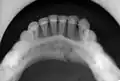 occlusal radiograph of a mandibular parasymphysis fracture