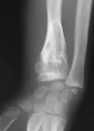 X-ray wrist: Ollier disease in child
