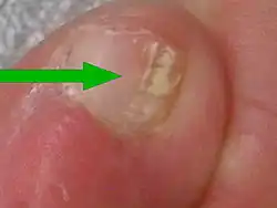 Fungal nail infection