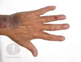 Osler node on ring finger