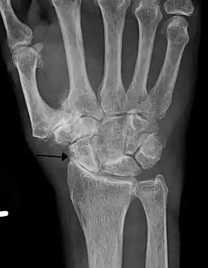 Severe osteoarthritis and osteopenia of the carpal joint and 1st carpometacarpal joint.
