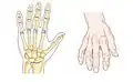 Bone (left) and clinical (right) changes of the hand in osteoarthritis