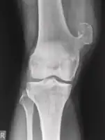 Osteochondroma